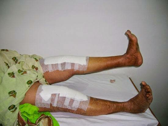 Pre And Post Surgical Rehab